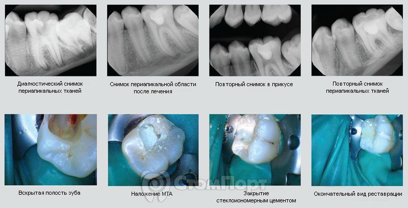 Клинический случай 4 - Случайное вскрытие и последующая реставрация зуба