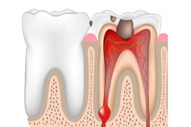 Лечение пульпита временных и постоянных зубов thumbnail