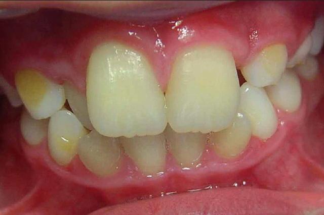 Макродентия