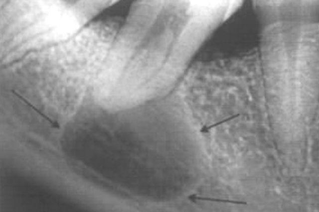 Одонтогенная киста фото
