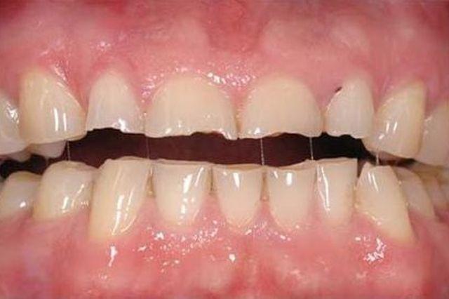 Сжатие зубов причины и лечение thumbnail