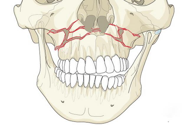 Перелом челюсти со смещением фото