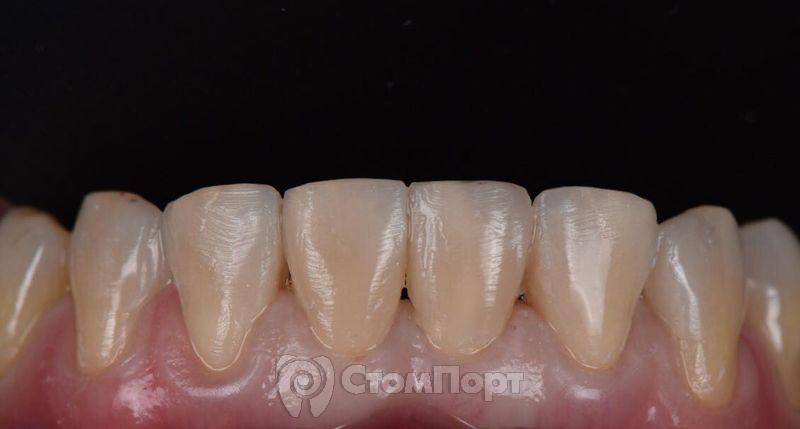 Прямой мокап 6 передних нижних зубов