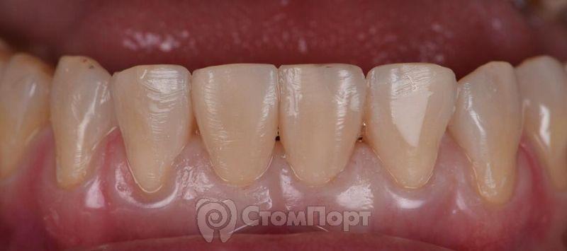 Прямой мокап 6 передних нижних зубов-2