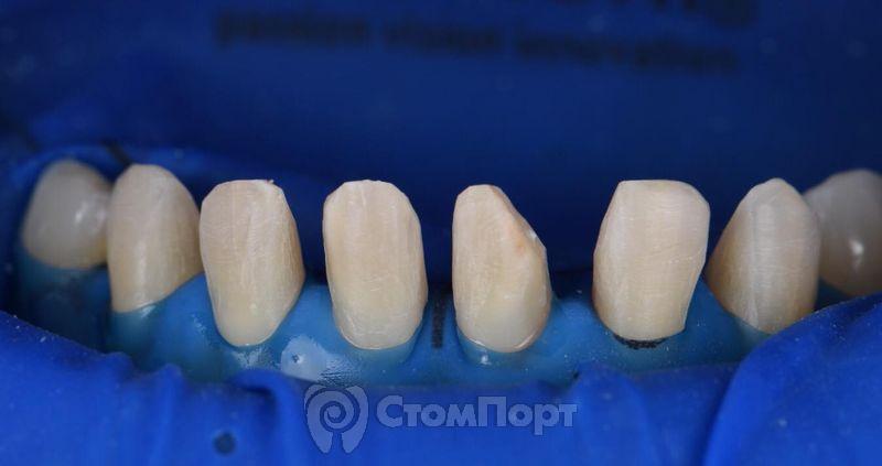 Зубы после снятия мокапа