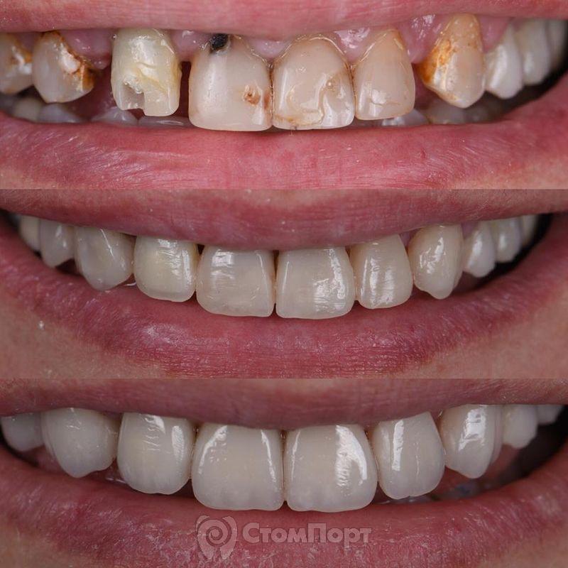 Реставрация семи передних верхних зубов-1