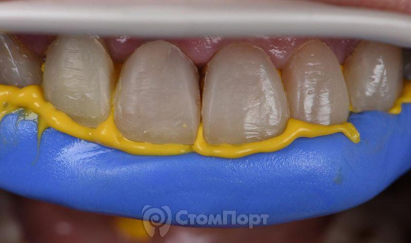Реставрация семи передних верхних зубов-10