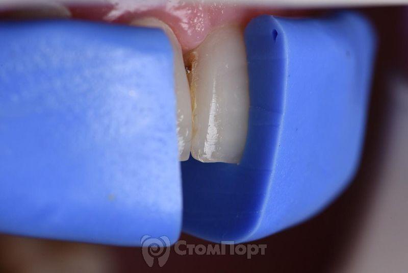 Реставрация семи передних верхних зубов-12