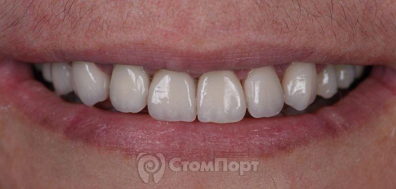 Реставрация семи передних верхних зубов-24