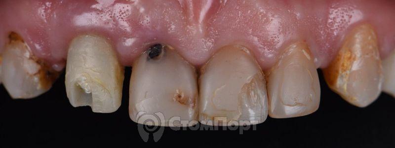 Реставрация семи передних верхних зубов-3