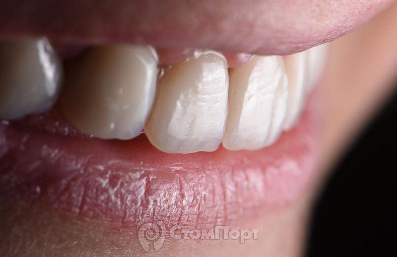 Реставрация семи передних верхних зубов-33