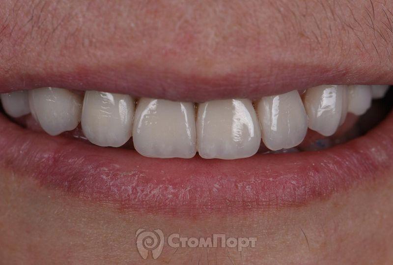 Реставрация семи передних верхних зубов-34