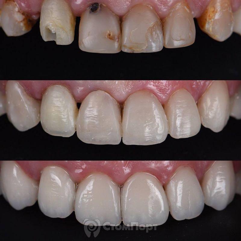 Реставрация семи передних верхних зубов-35