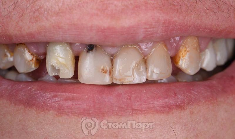 Реставрация семи передних верхних зубов-4
