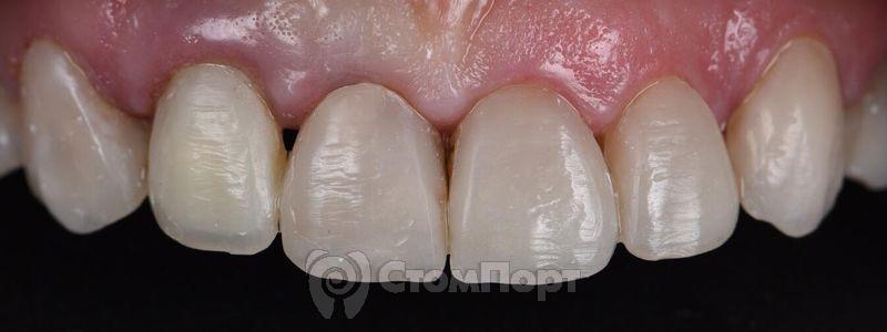 Реставрация семи передних верхних зубов-5