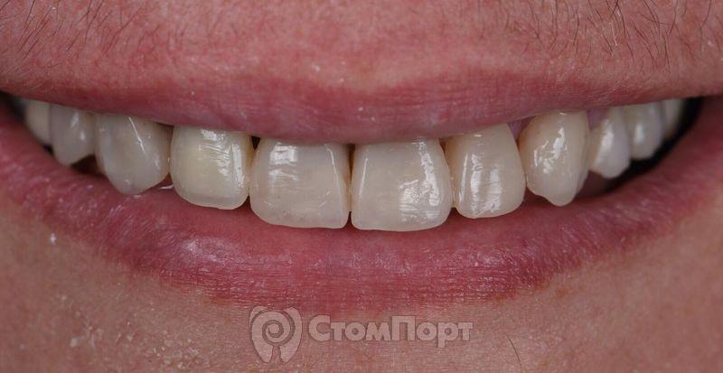 Реставрация семи передних верхних зубов-6