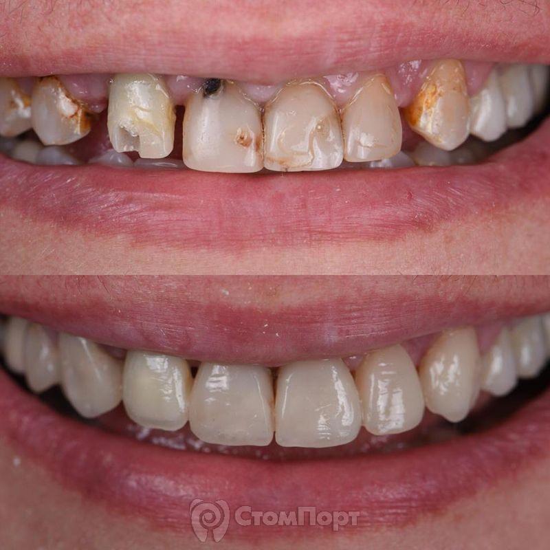 Реставрация семи передних верхних зубов-7