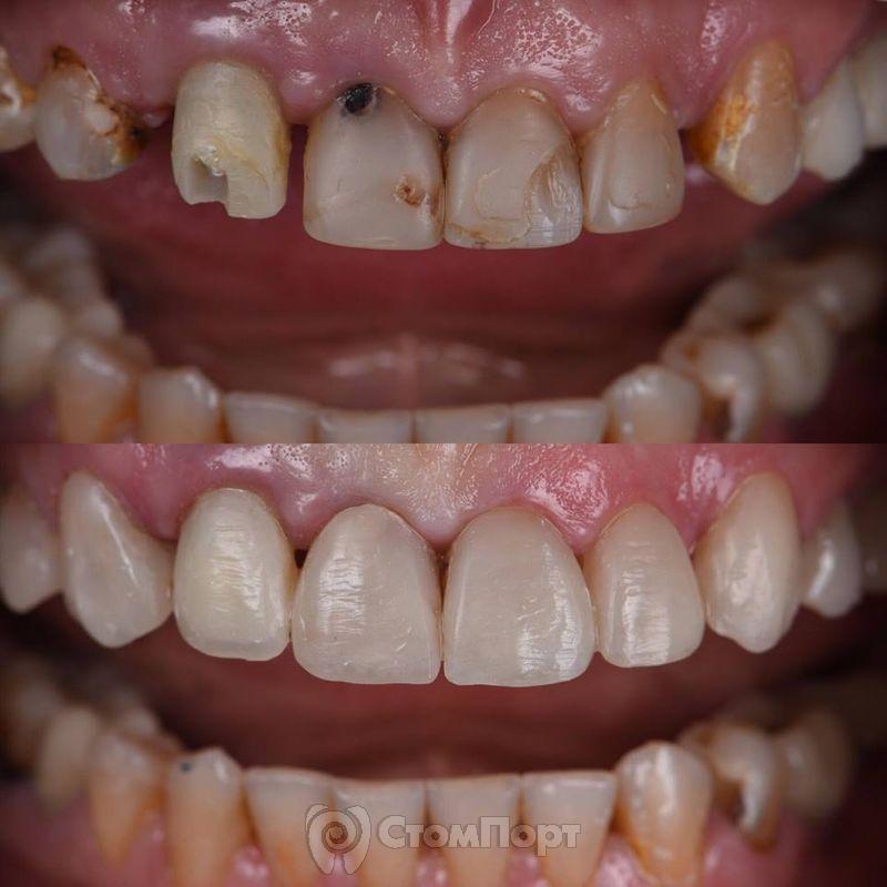 Реставрация семи передних верхних зубов-9
