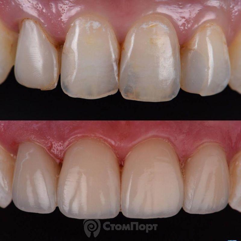 Реставрация верхних резцов с исправлением осей зубов-1