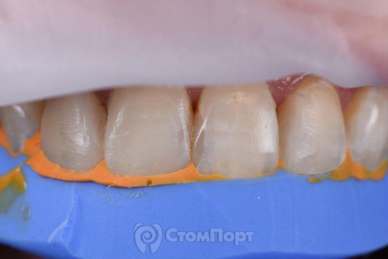 Реставрация верхних резцов с исправлением осей зубов-10