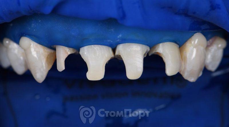 Реставрация верхних резцов с исправлением осей зубов-12