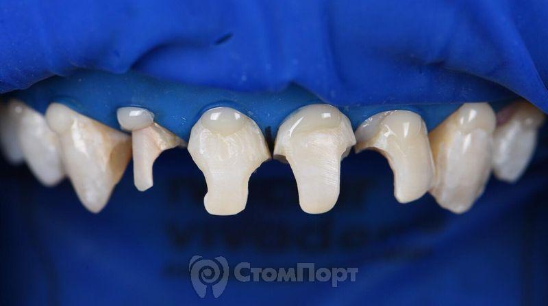 Реставрация верхних резцов с исправлением осей зубов-13