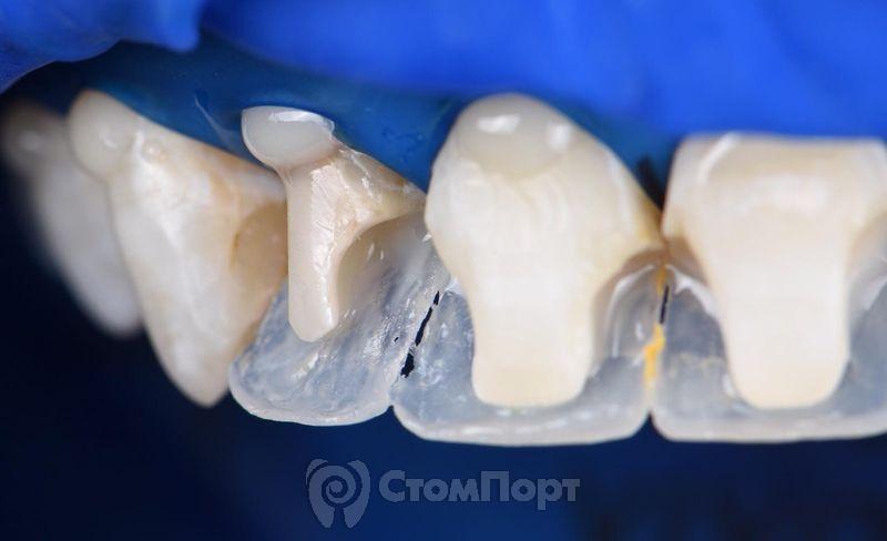 Реставрация верхних резцов с исправлением осей зубов-14