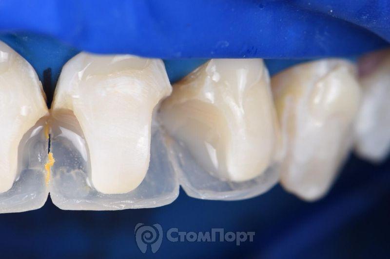 Реставрация верхних резцов с исправлением осей зубов-15