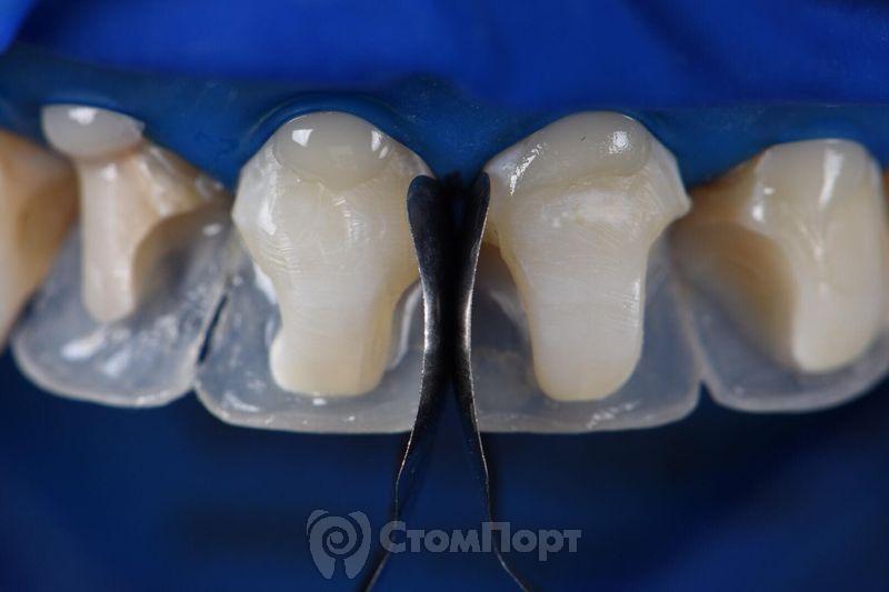 Реставрация верхних резцов с исправлением осей зубов-16