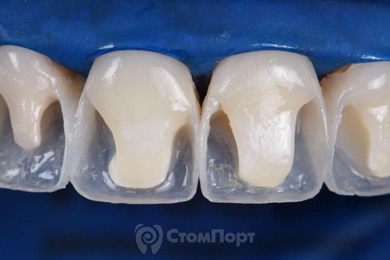 Реставрация верхних резцов с исправлением осей зубов-17