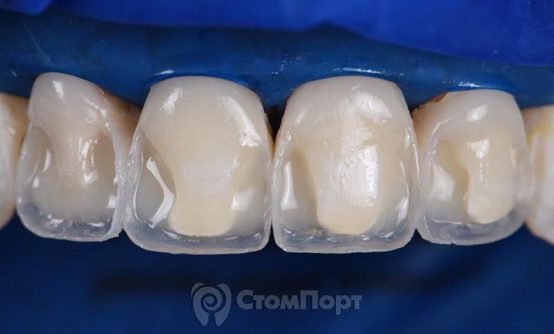 Реставрация верхних резцов с исправлением осей зубов-18