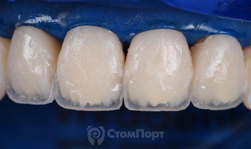 Реставрация верхних резцов с исправлением осей зубов-19