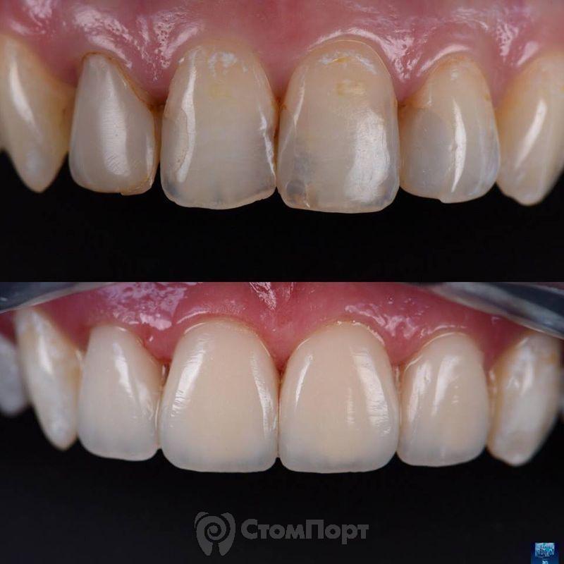 Реставрация верхних резцов с исправлением осей зубов-2