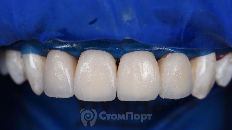 Реставрация верхних резцов с исправлением осей зубов-21
