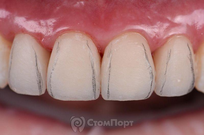 Реставрация верхних резцов с исправлением осей зубов-22