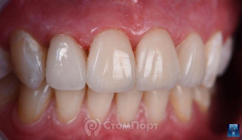 Реставрация верхних резцов с исправлением осей зубов-26