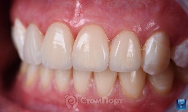 Реставрация верхних резцов с исправлением осей зубов-27