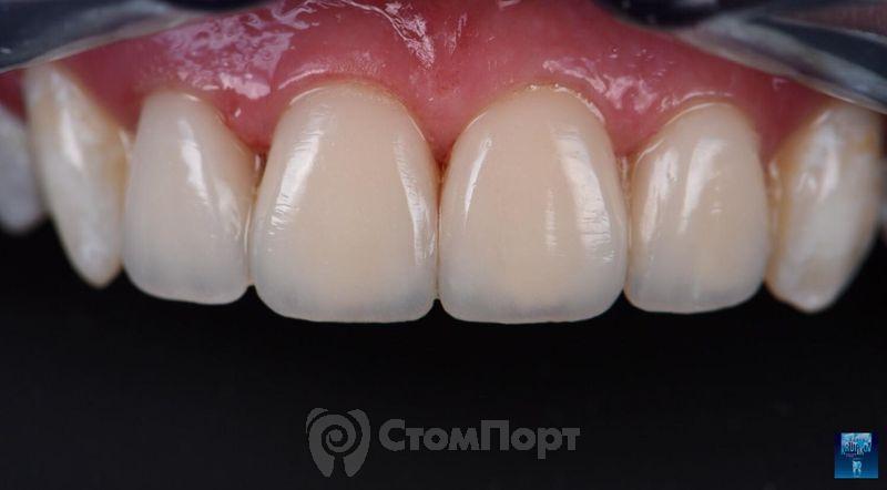Реставрация верхних резцов с исправлением осей зубов-28