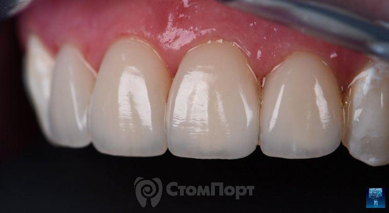 Реставрация верхних резцов с исправлением осей зубов-29