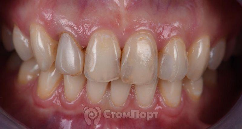 Реставрация верхних резцов с исправлением осей зубов-3