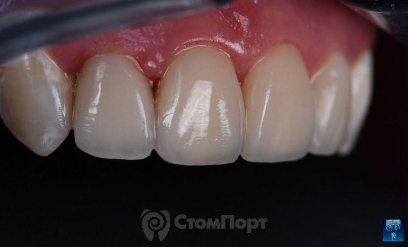 Реставрация верхних резцов с исправлением осей зубов-30
