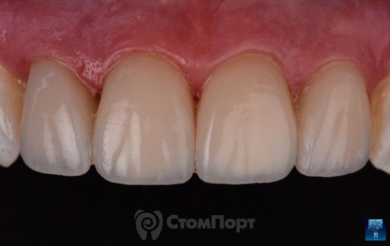 Реставрация верхних резцов с исправлением осей зубов-31
