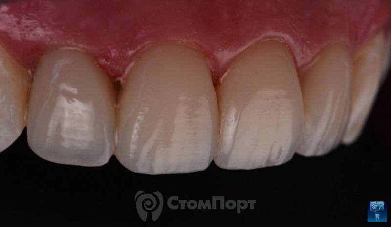 Реставрация верхних резцов с исправлением осей зубов-32