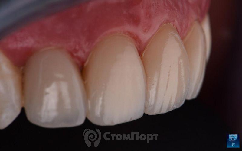 Реставрация верхних резцов с исправлением осей зубов-33