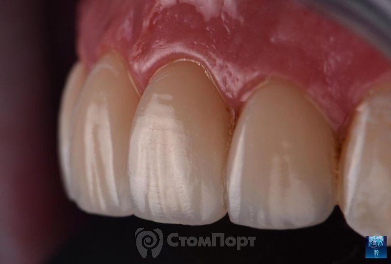 Реставрация верхних резцов с исправлением осей зубов-34