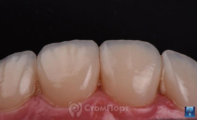 Реставрация верхних резцов с исправлением осей зубов-35