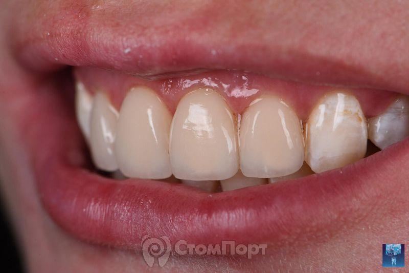 Реставрация верхних резцов с исправлением осей зубов-37