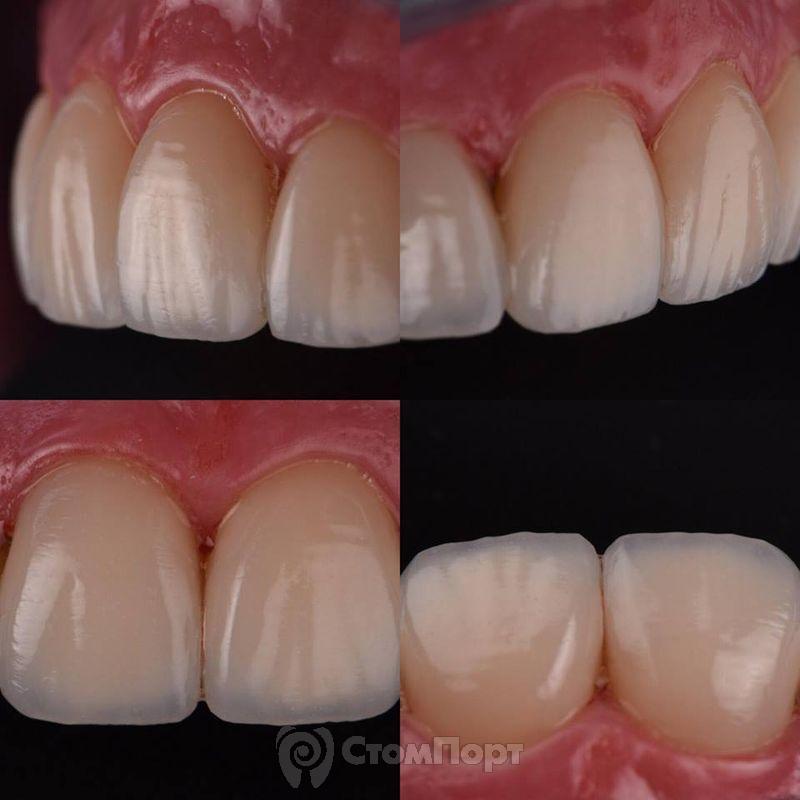 Реставрация верхних резцов с исправлением осей зубов-38