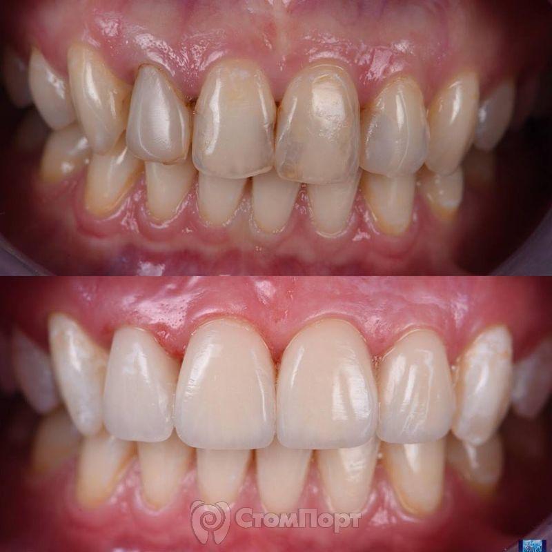 Реставрация верхних резцов с исправлением осей зубов-39