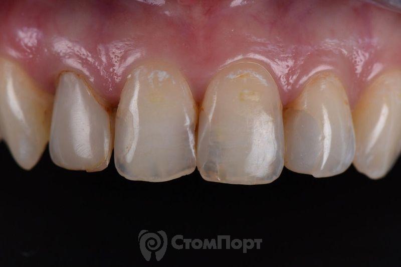 Реставрация верхних резцов с исправлением осей зубов-4